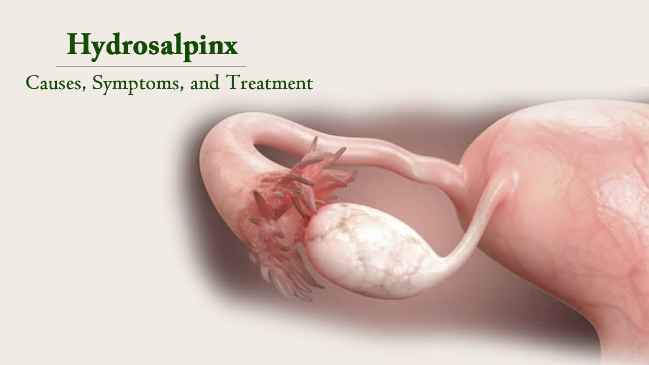 Hydrosalpinx (Blocked Fallopian Tube)