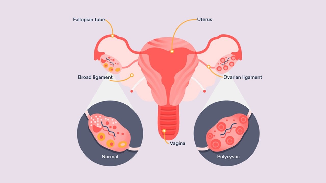 pcod and pcos treatment