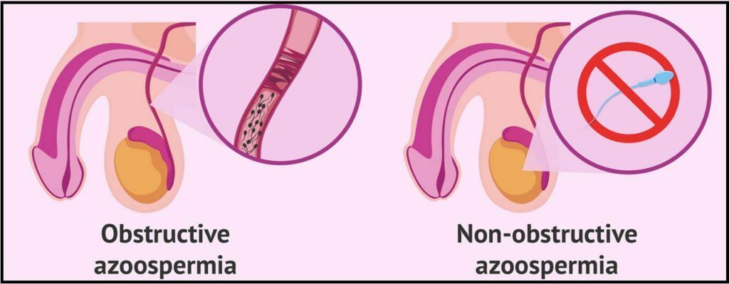 Types of Azoospermia, 