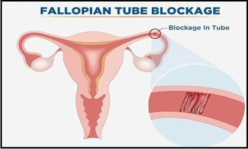 फैलोपियन ट्यूब , फैलोपियन ट्यूब खोलने के घरेलू उपाय