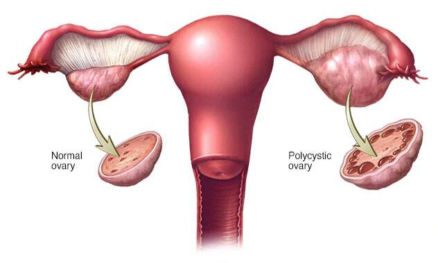 PCOS/PCOD, Ayurvedic Treatment for PCOS/PCOD