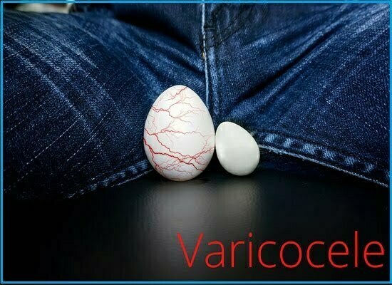 वैरीकोसेल क्या होता है , What is varicocele and how can it be removed by diet