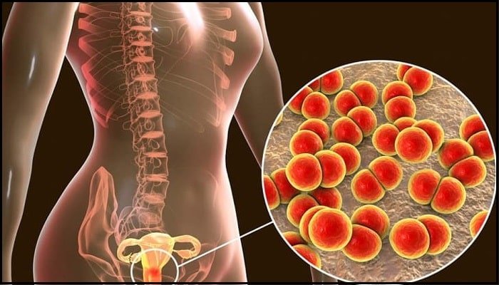 एंडोमेट्रियोसिस क्या है?  - What is endometriosis