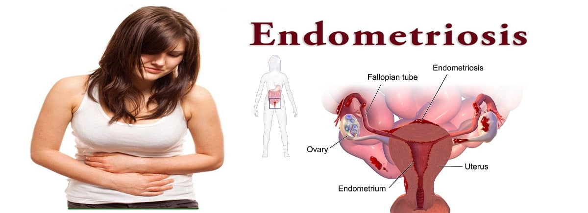 एंडोमेट्रियोसिस , एंड्रियोमेट्रियोसिस