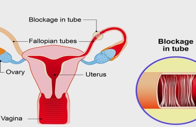 गर्भाशय ट्यूब | फैलोपियन ट्यूब की रुकावट