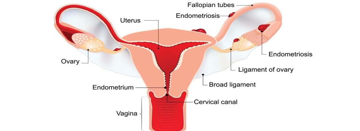 endometriosis treatment, endometriosis ka upchar