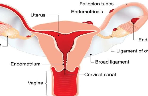 endometriosis treatment, endometriosis ka upchar
