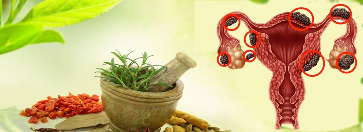 एंड़ोमेट्रियोसिस का इलाज - ENDOMETRIOSIS TREATMENT IN AYURVEDA