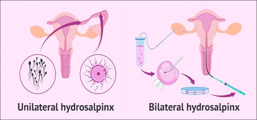 hydrosalpinx causes or treatment