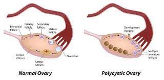 pcos