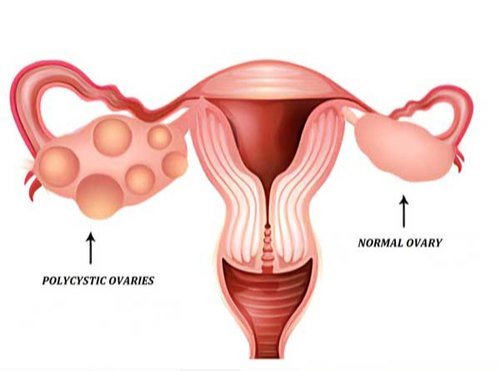 PCOS