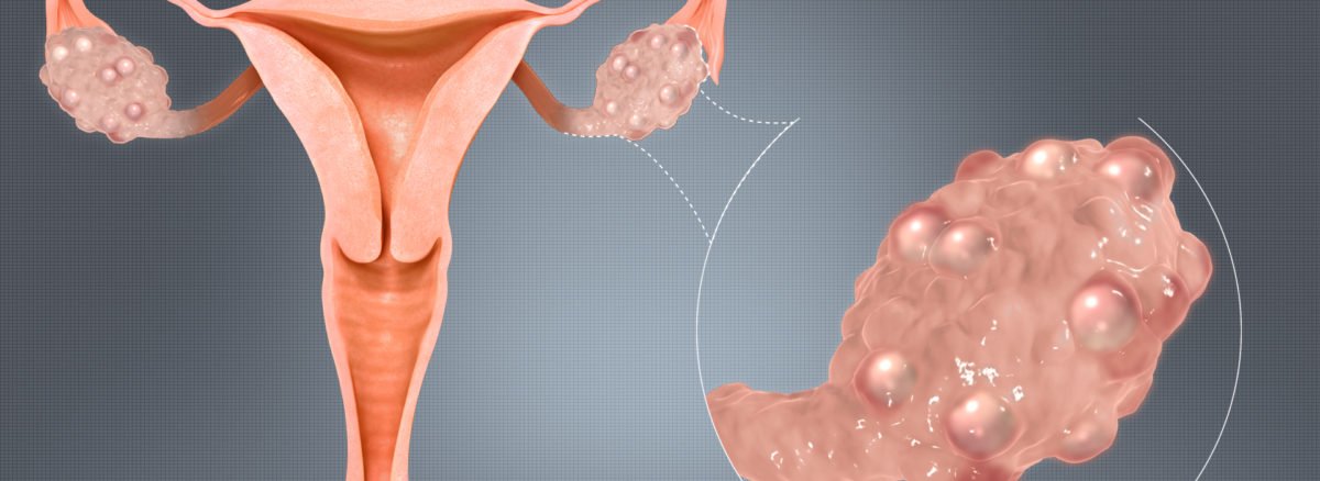 PCOS and pcod