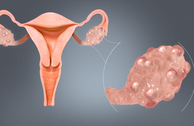 PCOS and pcod