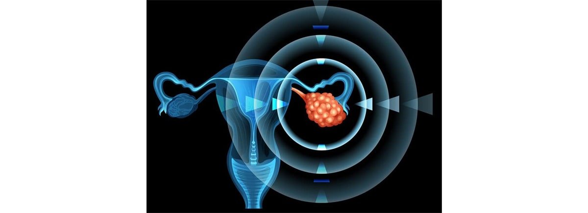 ovarian cancer: causes, symptoms, and treatments