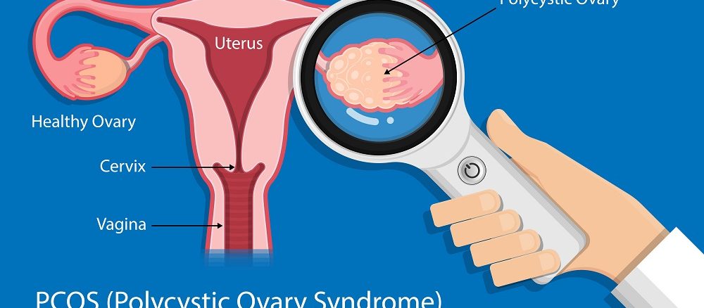 pcos ka ilaj