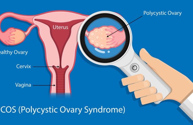 pcos ka ilaj