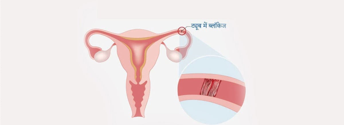 fallopian tube block