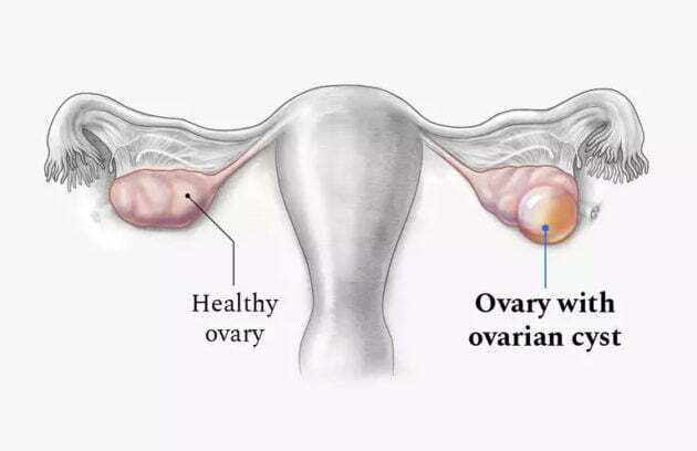 overlain cyst