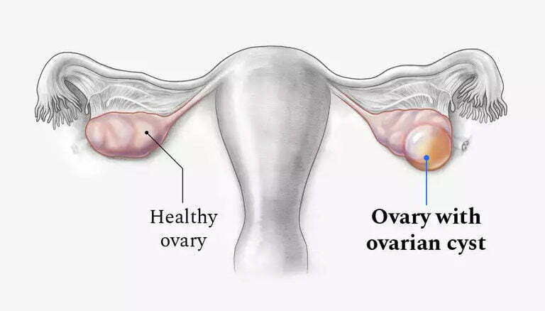 overlain cyst