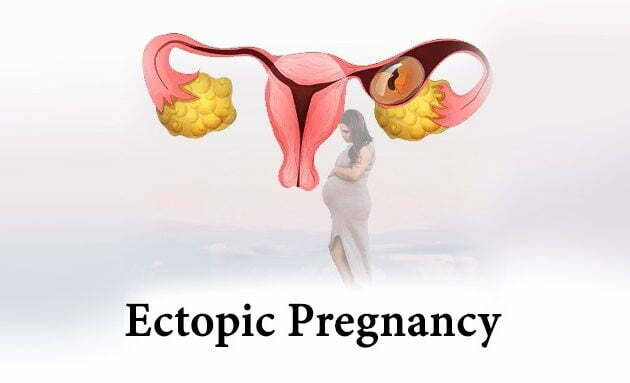 Ectopic Pregnancy, ectopic pregnancy in hindi