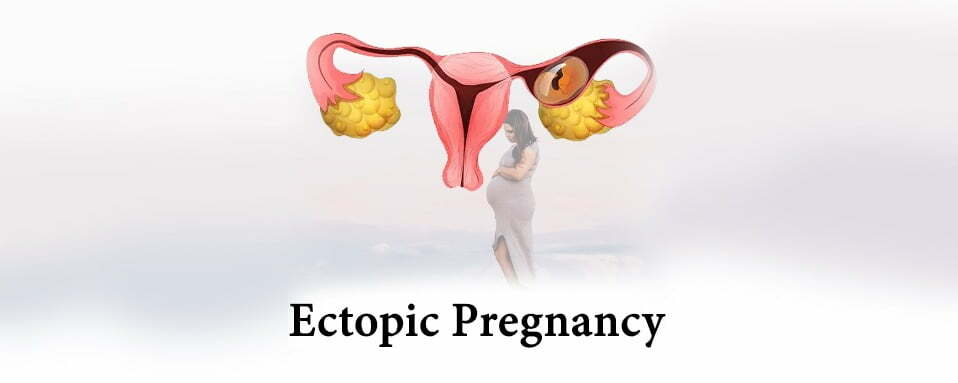 Ectopic Pregnancy, ectopic pregnancy in hindi