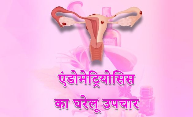 Endometriosis treatment, endometriosis home remedies