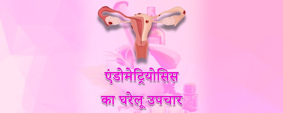 Endometriosis treatment, endometriosis home remedies