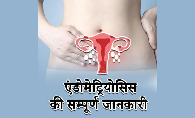 endometriosis full information, endometriosis