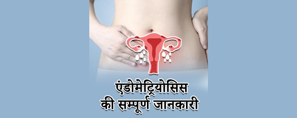 endometriosis full information, endometriosis