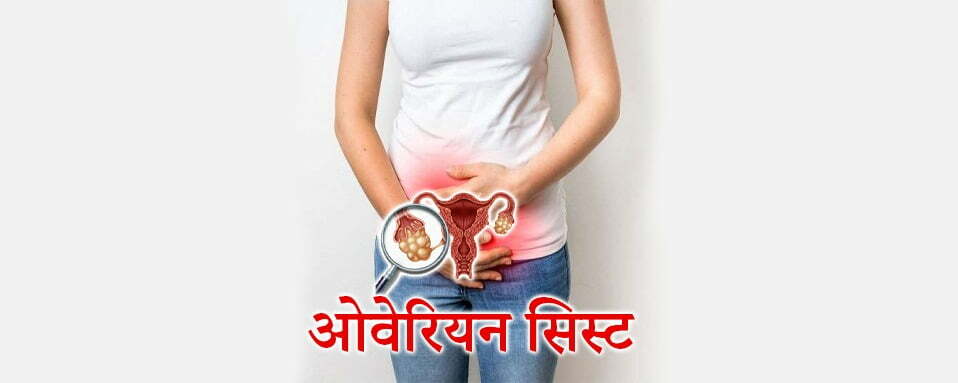 ovarian cyst in hindi, dr chanchal sharma