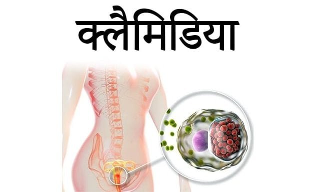 Chlamydia, क्लैमिडिया के लक्षण, क्लैमाइडिया क्या है