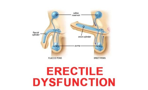 erectile dysfunction, नपुसंकता | Erectile Dysfunction in Hindi