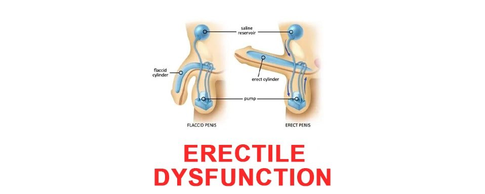 erectile dysfunction, नपुसंकता | Erectile Dysfunction in Hindi