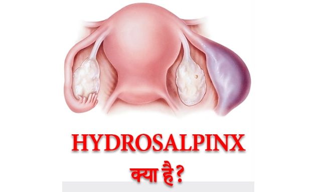 Hydrosalpinx kya hai?, what is Hydrosalpinx ?