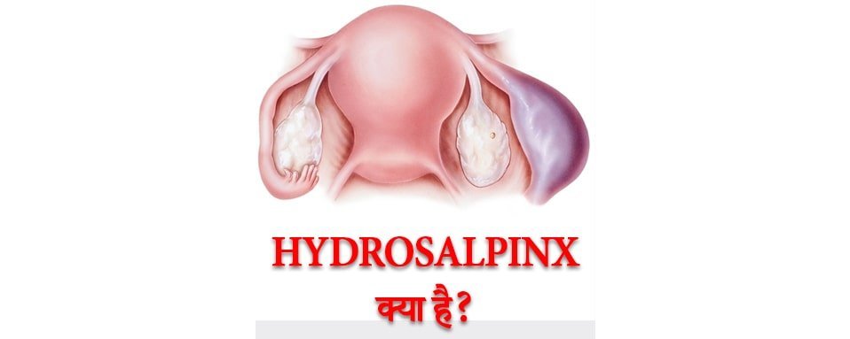 Hydrosalpinx kya hai?, what is Hydrosalpinx ?