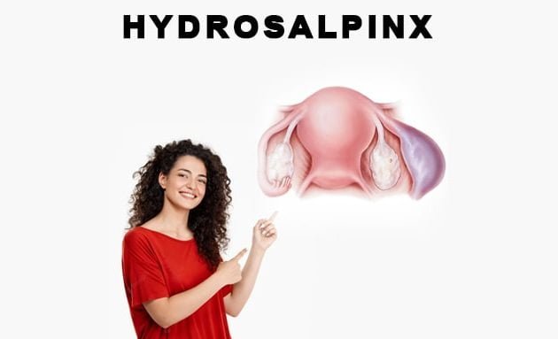 hydrosalpinx, hydrosalpinx ki puri jankari, hydrosalpinx full information in hindi