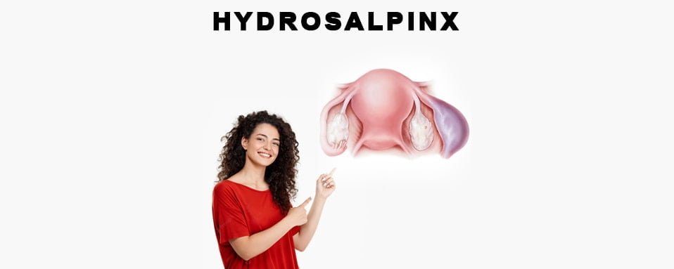 hydrosalpinx, hydrosalpinx ki puri jankari, hydrosalpinx full information in hindi