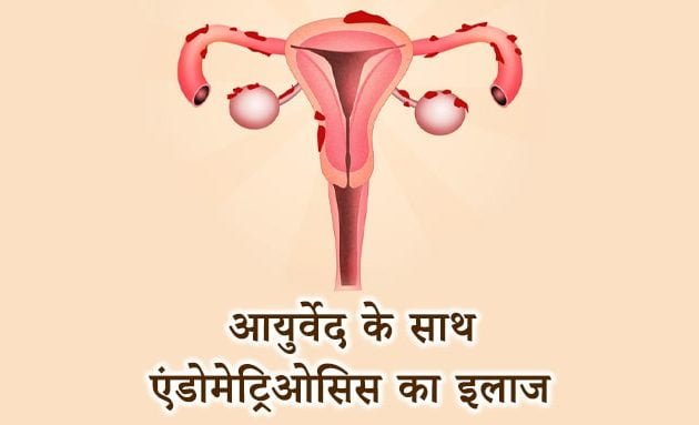 endometriosis treatment with ayurveda, ayurvedic tarike se endometriosis ka upchar