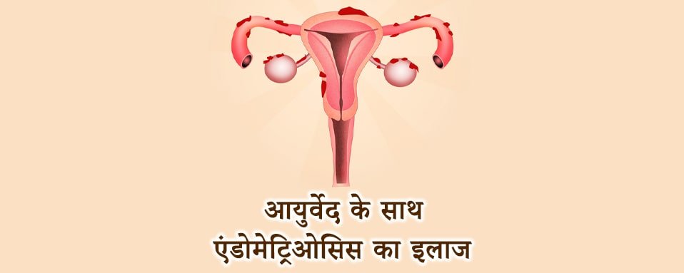 endometriosis treatment with ayurveda, ayurvedic tarike se endometriosis ka upchar