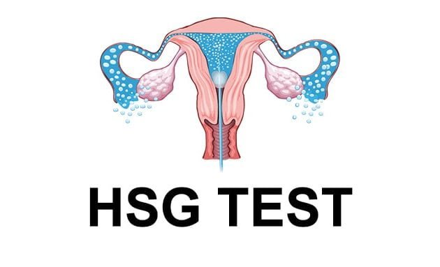 HSG Test, हिस्टेरोसाल्पिंगोग्राफी, Hysterosalpingography