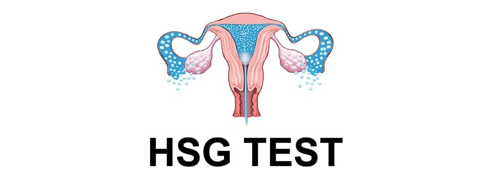 HSG Test, हिस्टेरोसाल्पिंगोग्राफी, Hysterosalpingography