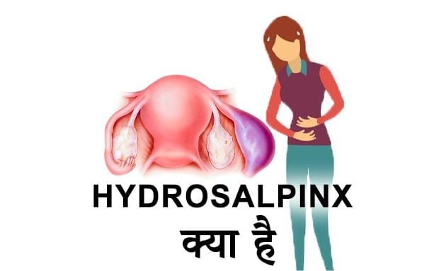 what is hydrosalpinx in hindi, hydrosalpinx, हाइड्रोसालपिनक्स कारण और जोखिम कारक