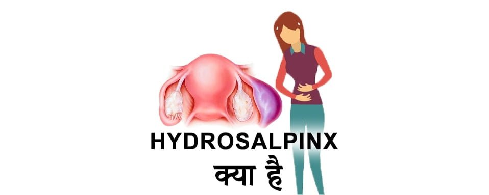 what is hydrosalpinx in hindi, hydrosalpinx, हाइड्रोसालपिनक्स कारण और जोखिम कारक