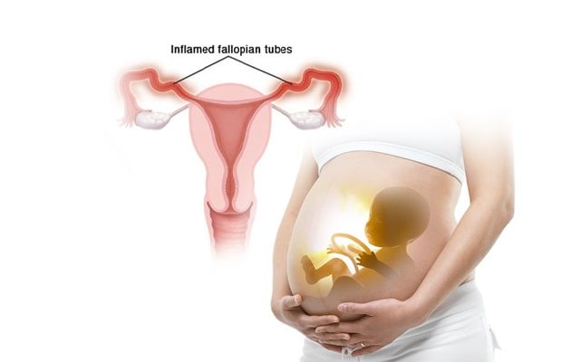 Fallopian Tube Blockage Treatment in Hindi