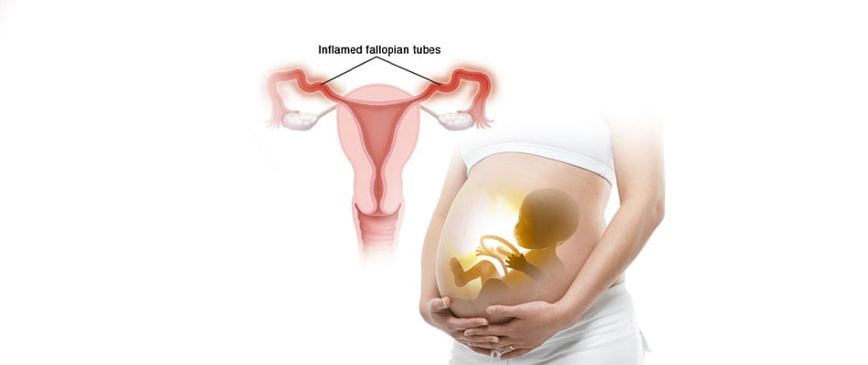 Fallopian Tube Blockage Treatment in Hindi