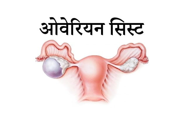 Ovarian cyst in hindi, ओवरियन सिस्ट के लक्षण और आयुर्वेदिक उपाय