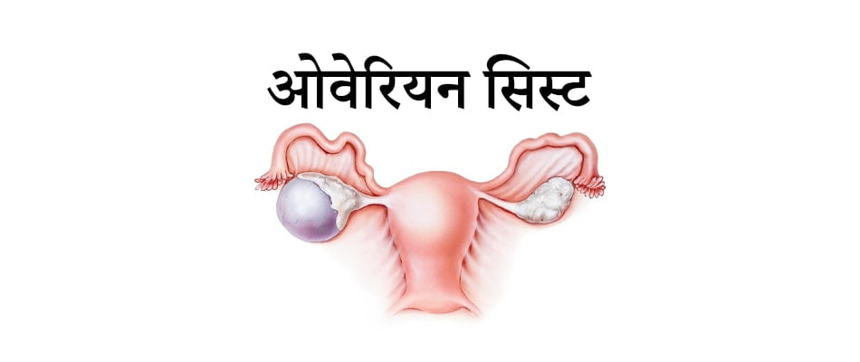 Ovarian cyst in hindi, ओवरियन सिस्ट के लक्षण और आयुर्वेदिक उपाय