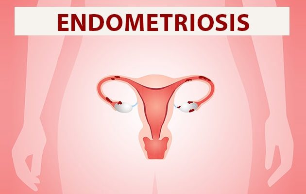 एंडोमेट्रिओसिस के लक्षण, कारण, इलाज, दवा, उपचार और नुकसान  - Endometriosis in Hindi