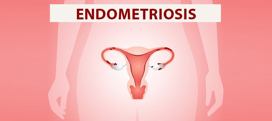 एंडोमेट्रिओसिस के लक्षण, कारण, इलाज, दवा, उपचार और नुकसान  - Endometriosis in Hindi