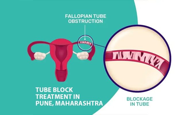 Tube Block Treatment in Pune, Maharashtra
